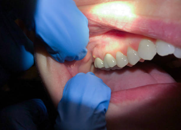 Best Emergency Dental Care for Sports Injuries in Deer Park, IL